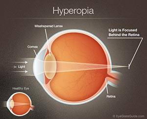 hyperopia farsighted symptoms signs